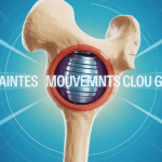 clou gamma mouvements interdits illustration fémur implant